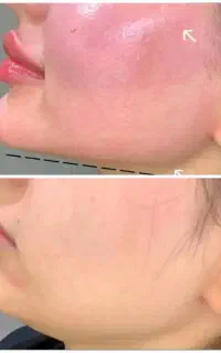 فیلر بوتاکس