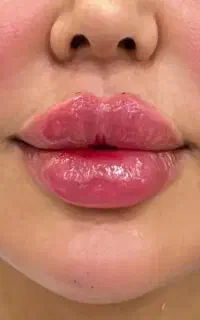 تخفیف  بوتاکس