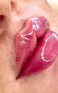 آموزش5ت انجام خدمات زیبایی بوتاکس و ژل۳۰۰