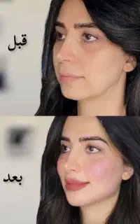 لیفت صورت نخ،ژل لب بوتاکس هایفو لیزر موتیتانیومprp