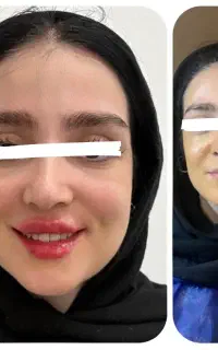 تزریق چربی ژل‌لب/هیپ‌دیپ/باسن/غبغب/صورت