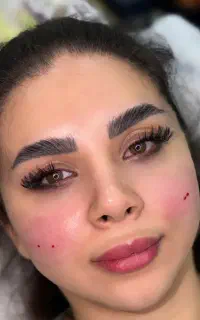 فیلر ،بوتاکس،پوست کره ای ،مزو ،مزوژل