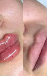 فیلر .بوتاکس .پلکسر.مزونیدلینگ