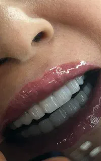 کامپوزیت دندان اقساطی بدون پیش پرداخت واحدی ۱/۵۰۰