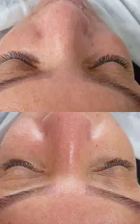 فشیال اپیلاسیون