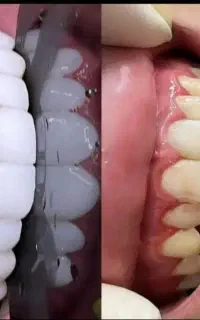 جشنواره کامپوزیت ،روکش..