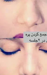تکنیک آواتار تک جلسه بدون جراحی وبازگشت توسط پزشک