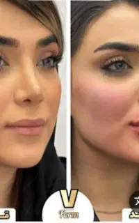فیلر.ژل.بوتاکس کل صورت۹۵۰ ت ۶۰درصد تخفیفات واقعی