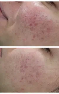 پاکسازی و فیشیال تخصصی پوست در یزد، ویژه بانوان