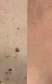 ازبین برنده زگیل