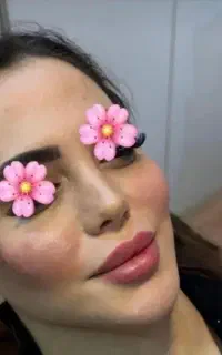 تزریق ژل و فیلرصورت ب مدت محدود1/200