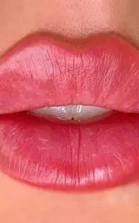 تزریق ژل وپی ارپی