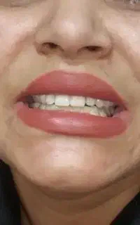 دندانسازی ماهر یزد در کرمان ، دست دندان کامل ۱۰ م