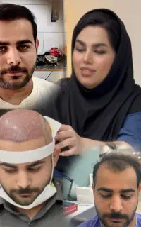 کاشت مو شیراز(خانم بهروزی)، پرتراکم ترین در ایران
