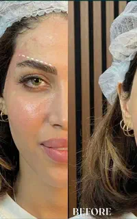 لیفت ابرو و چشم بدون جراحی با تکنیک اوت لاین