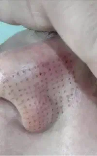 پاکسازی پوست  با دستگاه و با مواد.
