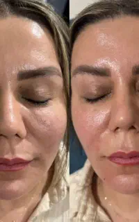 تزریق فیلر و بوتاکس با آف ویژه