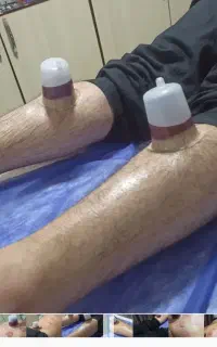 حجامت درمانی ، ماساژ درمانی ، زالو درمانی