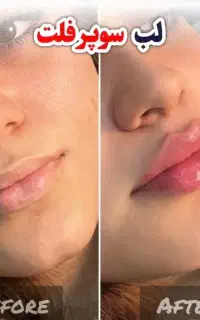 تخفیفات ژل و بوتاکس و نخ توسط شخص دکترچابکی