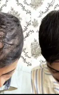 پروتز مو و کاشت مو راهش نیست