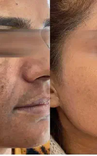 لیزرلک تاتو ترک پوستی ماه گرفتگی لیزرموی زائدلاغری