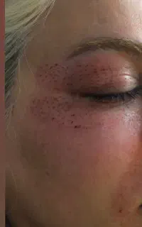 پلاسماجت افتادگی پلک لیفت