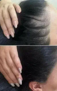 پایان ریزش مو تضمینی