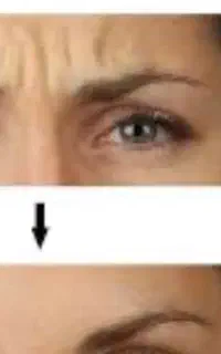 جشنواره بوتاکس ۲۹۰ لیفت شقیقه