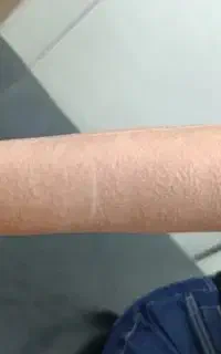 لیزر مو زائد با دستگاه الکس کندلا(آمریکائی اصل)