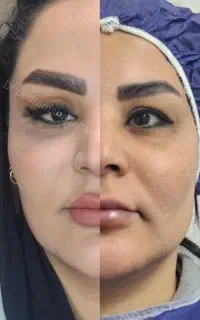 جراحی افتادگی پلک با بخیه نانولیزری فقط ۷.۹۹۰