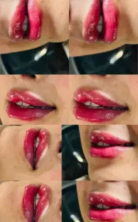تزریق ژل و بوتاکس با بهترین متریال