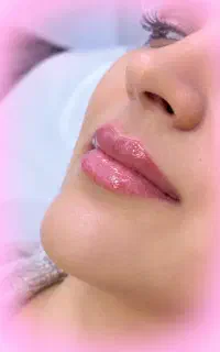 جشنواره تخفیف تزریق ژل و بوتاکس و جوانسازی