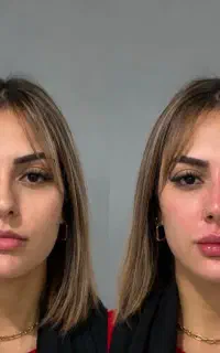 بوتاکس تضمینی فقط ۱۲۰۰