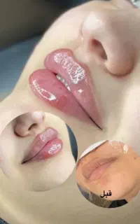 آف ژل و بوتاکس ،نخ، پی آرپی در کلینیک زیبایی‌