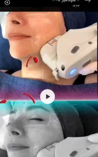 خدمات هایفوتراپی و لیفت صورت