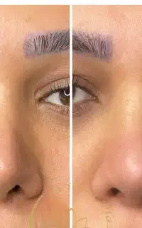 کوچک‌کردن‌بینی ‌رفع‌افتادگی‌پلک‌فیشال تخصصی درمانی