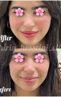 آموزش خدمات ژل بوتاکس آنزیم،پی ارپی،مزوتراپی