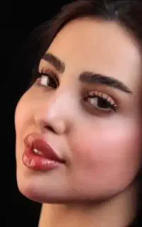 جشنواره تزریق فیلربادی بیکینی