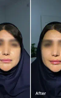 آف ژل و بوتاکس بمدت۵روز(تزریق توسط پزشک)
