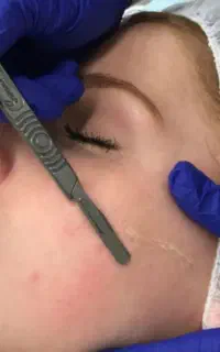 اصلاح تخصصی درماپلینگ