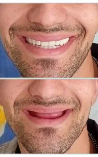 دندان مصنوعی(بدون ۱ریال سود/۳ الی۸ماهه/پذیرش بیمه)