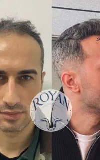 کاشت مو ۲۲ کاشت ابرو ۱۵
