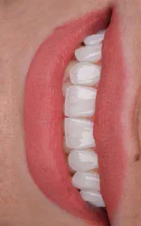 ایمپلنت دندان دیجیتال و فوری با اقساط بلند مدت