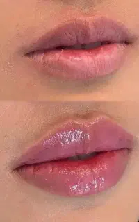 جشنواره ژل و بوتاکس فیلر توسط خانم دکتر چابکی