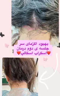 آموزش اسکراب اسکالپ سر به آقایان