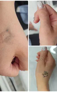 لیزر ریمو و پاک کردن تتو صورت و بدن ،کک و مک و لک