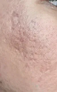 جشنواره 50% تزریق پروتئین ،PRPمعجزه ترمیم پوست