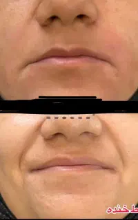 تزریق ژل و مزو وبوتاکس