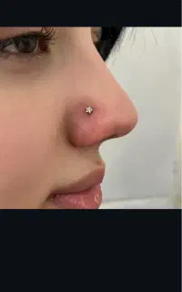 میکرودرمال چالگونه سوراخ کردن گوش نوزاد
