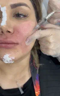 تزریق ژل و بوتاکس